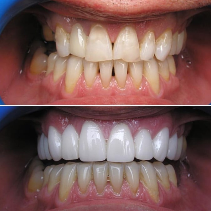 before and after look at a patient's smile when getting dental care at Smiles on Elston