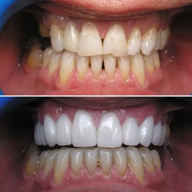 before and after look at a patient's smile when getting dental care at Smiles on Elston